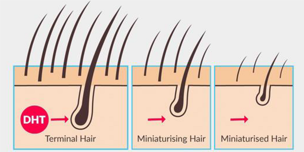 Erkek Tipi Saç Dökülmesi Nasıl Önlenir.png