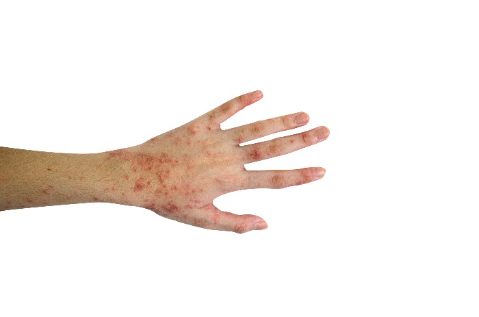 vecteezy_rash-and-skin-on-the-hand-isolated-on-white-background_4258314_copy_700x463.jpg